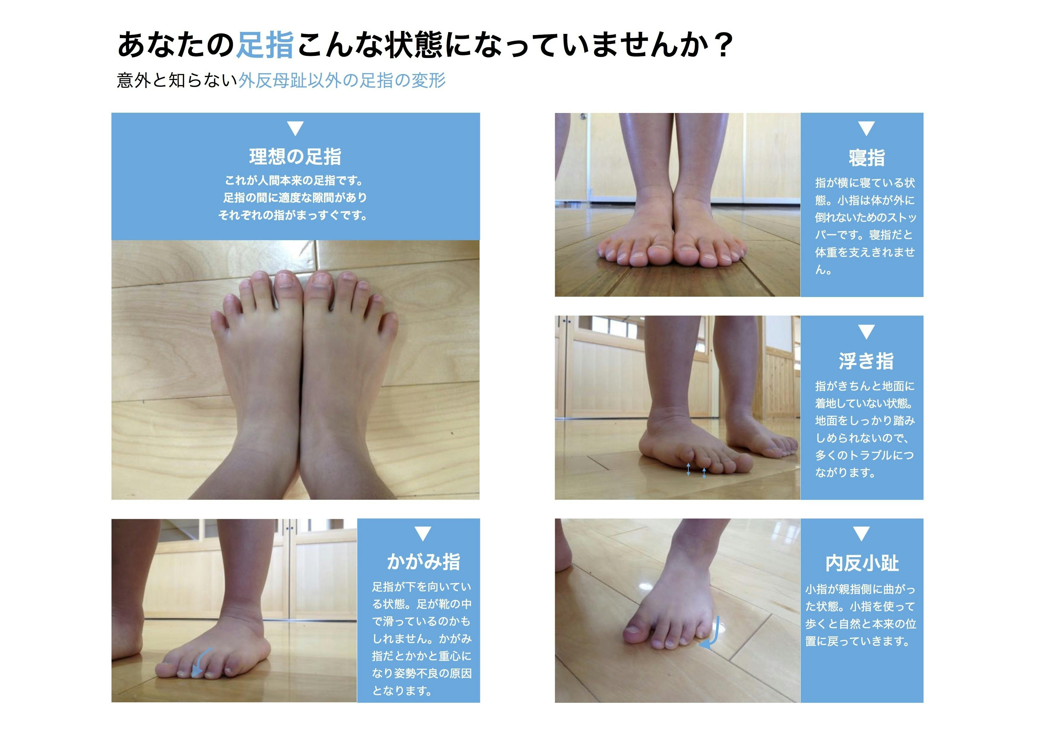 妻のo脚が1週間で改善し体調が良くなった感動を この靴下で多くの人に再現したい Campfire キャンプファイヤー 妻のo脚が1週間で改善し体調が良くなった感動を この靴下で多くの人に再現したい Campfire キャンプファイヤー