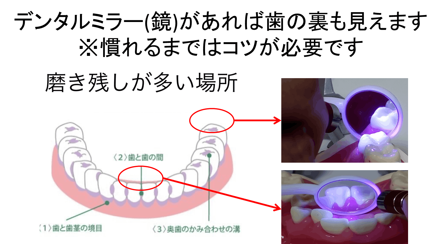マスク着用で歯のお手入れさぼってませんか おうちで簡単 歯垢 歯石検査ライト Campfire キャンプファイヤー マスク着用で歯のお手入れさぼってませんか おうちで簡単 歯垢 歯石検査ライト Campfire キャンプファイヤー