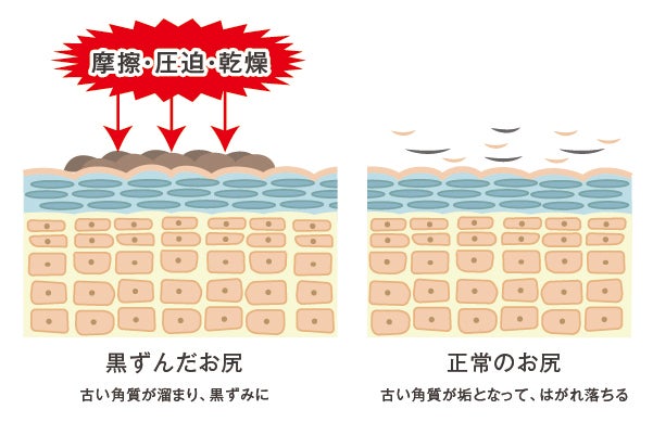 黒ずみバイバイ お尻 ワキ ヒジ ヒザ 股の黒ずみを解消する専用スキンケア Campfire キャンプファイヤー 黒ずみバイバイ お尻 ワキ ヒジ ヒザ 股の黒ずみを解消する専用スキンケア Campfire キャンプファイヤー