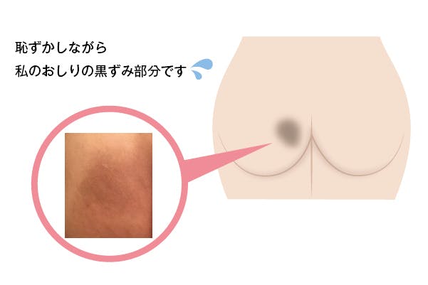 黒ずみバイバイ お尻 ワキ ヒジ ヒザ 股の黒ずみを解消する専用スキンケア Campfire キャンプファイヤー 黒ずみバイバイ お尻 ワキ ヒジ ヒザ 股の黒ずみを解消する専用スキンケア Campfire キャンプファイヤー