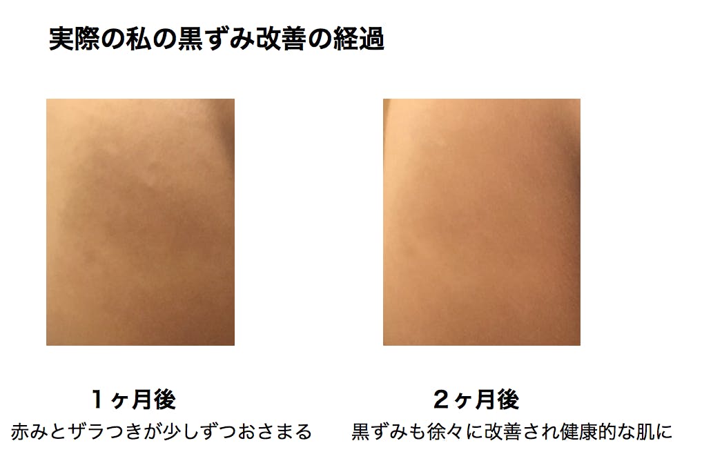黒ずみバイバイ お尻 ワキ ヒジ ヒザ 股の黒ずみを解消する専用スキンケア Campfire キャンプファイヤー 黒ずみバイバイ お尻 ワキ ヒジ ヒザ 股の黒ずみを解消する専用スキンケア Campfire キャンプファイヤー