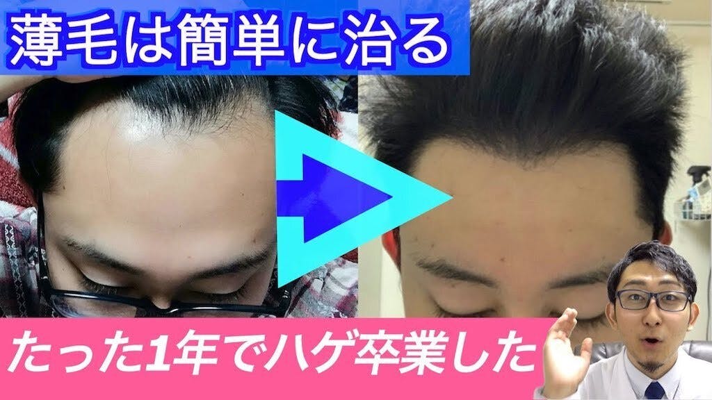 ハゲ対策先進国で取材したハゲ対策情報をyoutubeで伝えたい Campfire キャンプファイヤー ハゲ対策先進国で取材したハゲ対策情報をyoutubeで伝えたい Campfire キャンプファイヤー