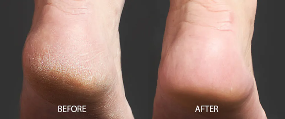 かかとチュルン 盛り上がった固い角質を除去 独自凹凸 ガラス製かかと角質ケア Campfire キャンプファイヤー