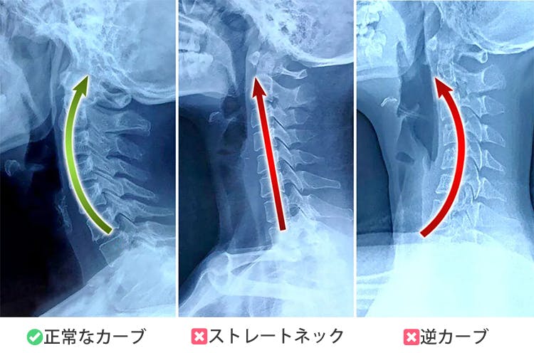 頸椎 逆 オファー カーブ 枕