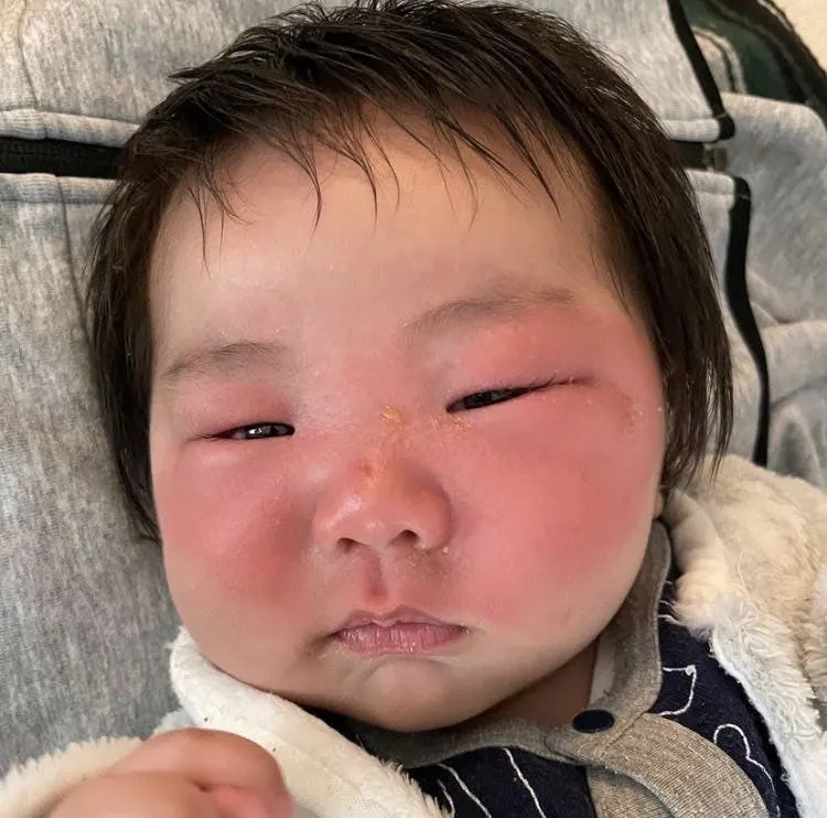 紫外線に当たれない難病 色素性乾皮症 Xp の子供たちのための防護服を作りたい Campfire キャンプファイヤー 紫外線に当たれない難病 色素性乾皮症 Xp の子供たちのための防護服を作りたい Campfire キャンプファイヤー