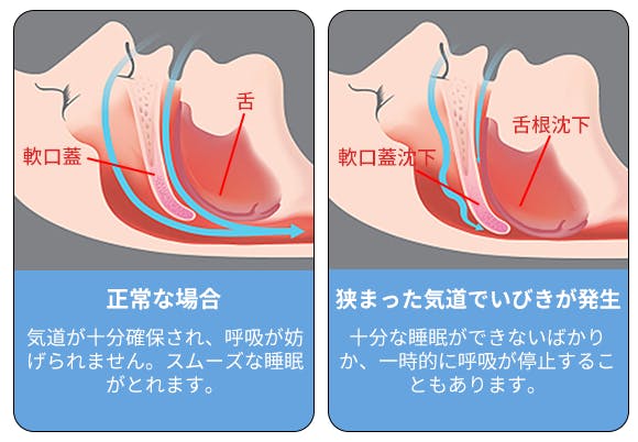 EMSパルス振動でいびきケア！アプリ不要・本体から睡眠時呼吸データを