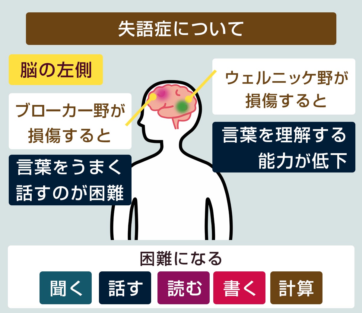 失語症の解説画像。言語野が損傷されると、聞く、話す、読む、書く、計算が困難になる。ブローカー野が損傷すると、言葉をうまく話すのが困難になります。ウェルニッケ野が損傷すると、言葉を理解する能力が低下します。