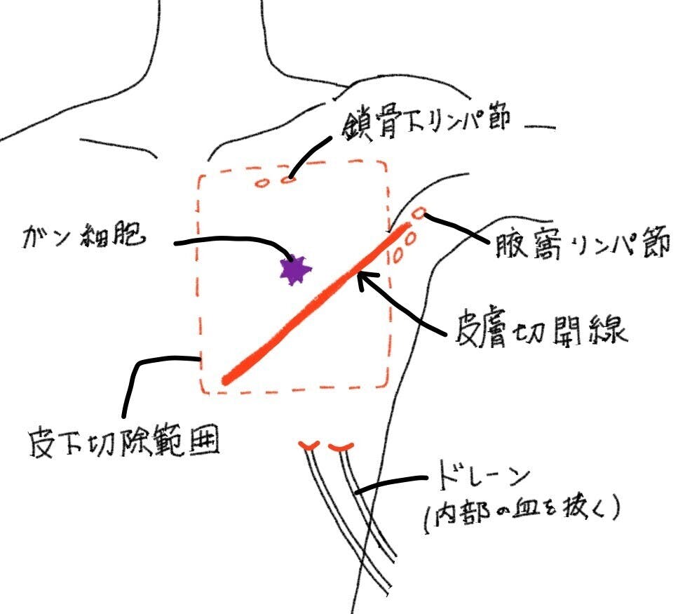 乳がん治療を応援 傷と肌に優しい術後ブラジャー Campfire キャンプファイヤー 乳がん治療を応援 傷と肌に優しい術後ブラジャー Campfire キャンプファイヤー