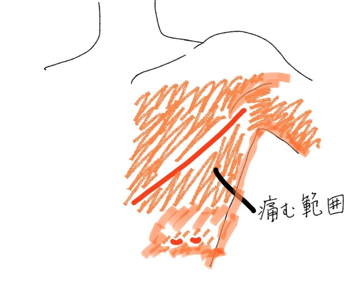 乳がん治療を応援 傷と肌に優しい術後ブラジャー Campfire キャンプファイヤー 乳がん治療を応援 傷と肌に優しい術後ブラジャー Campfire キャンプファイヤー