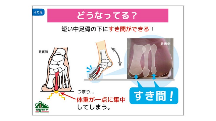 「イカ足」とは？ 3