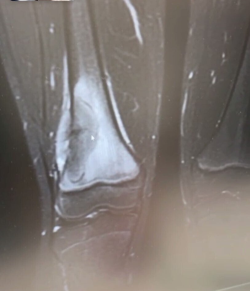 実際のレントゲン写真