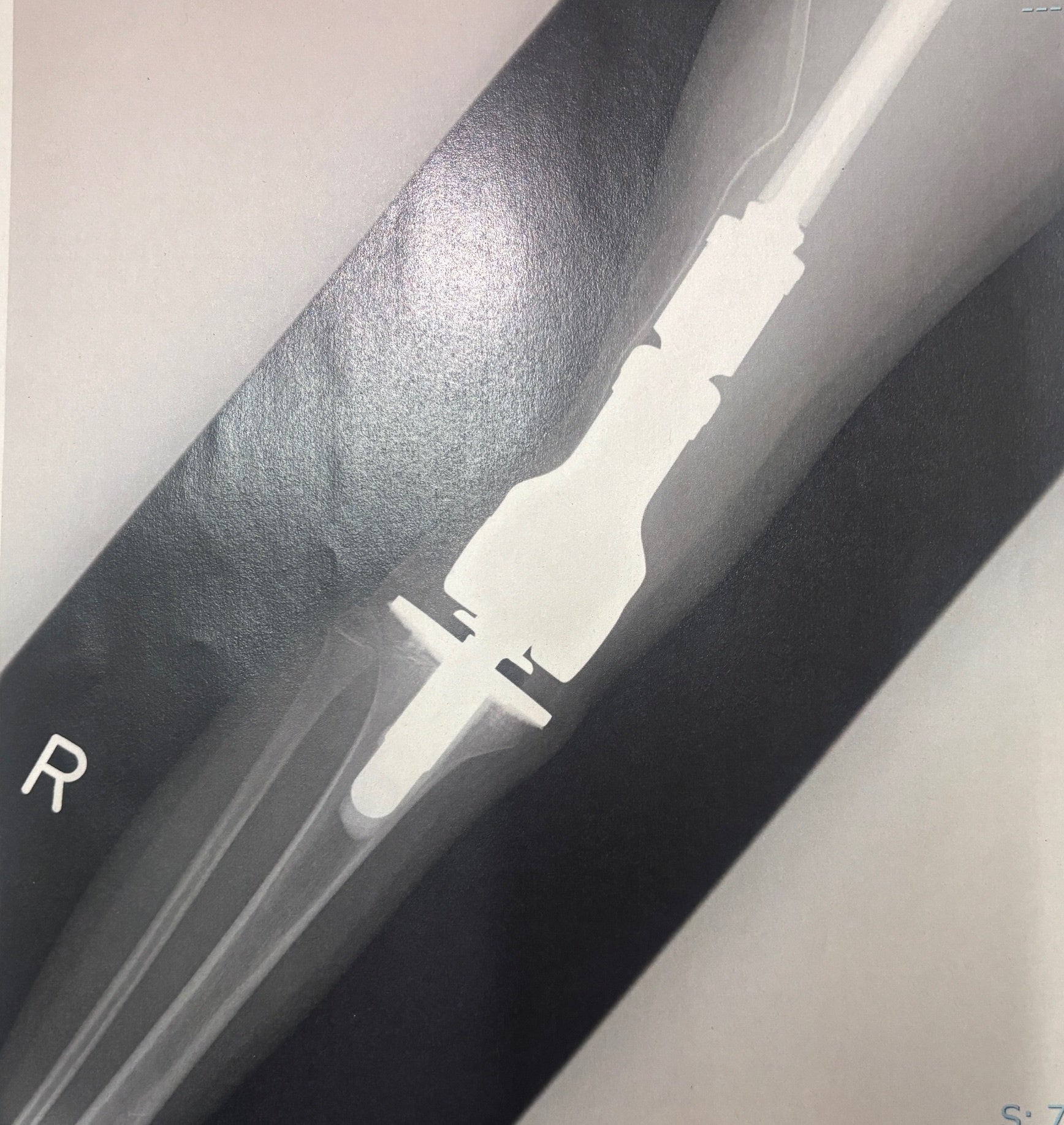 実際の手術後の人工関節のレントゲン