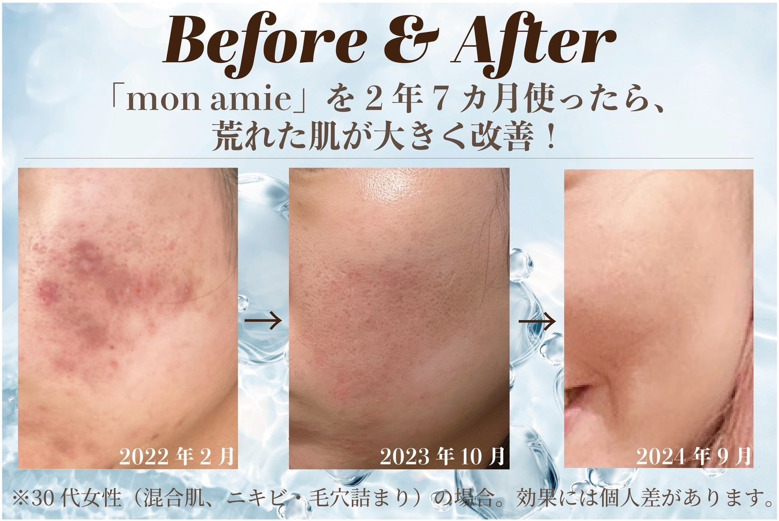 親友の奇跡！美容成分86％ジェル】Mon amieで