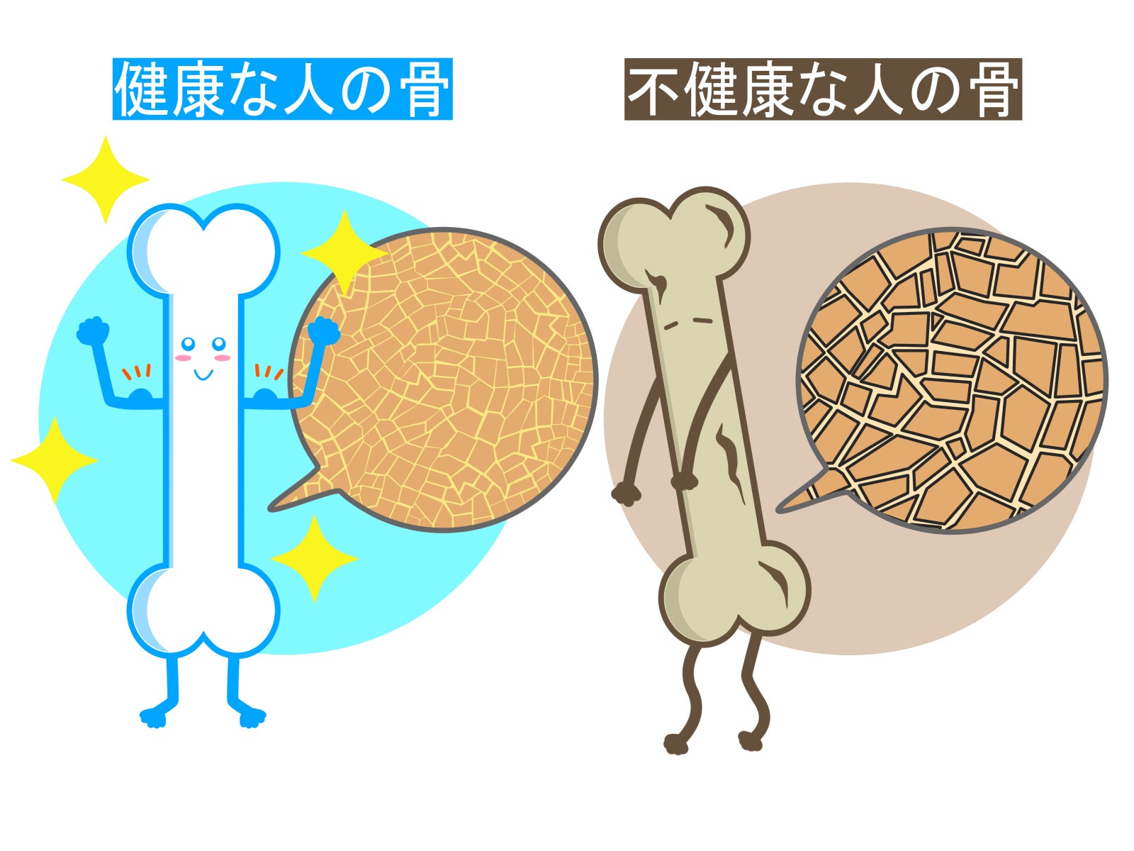 健康な骨と骨粗鬆症の骨