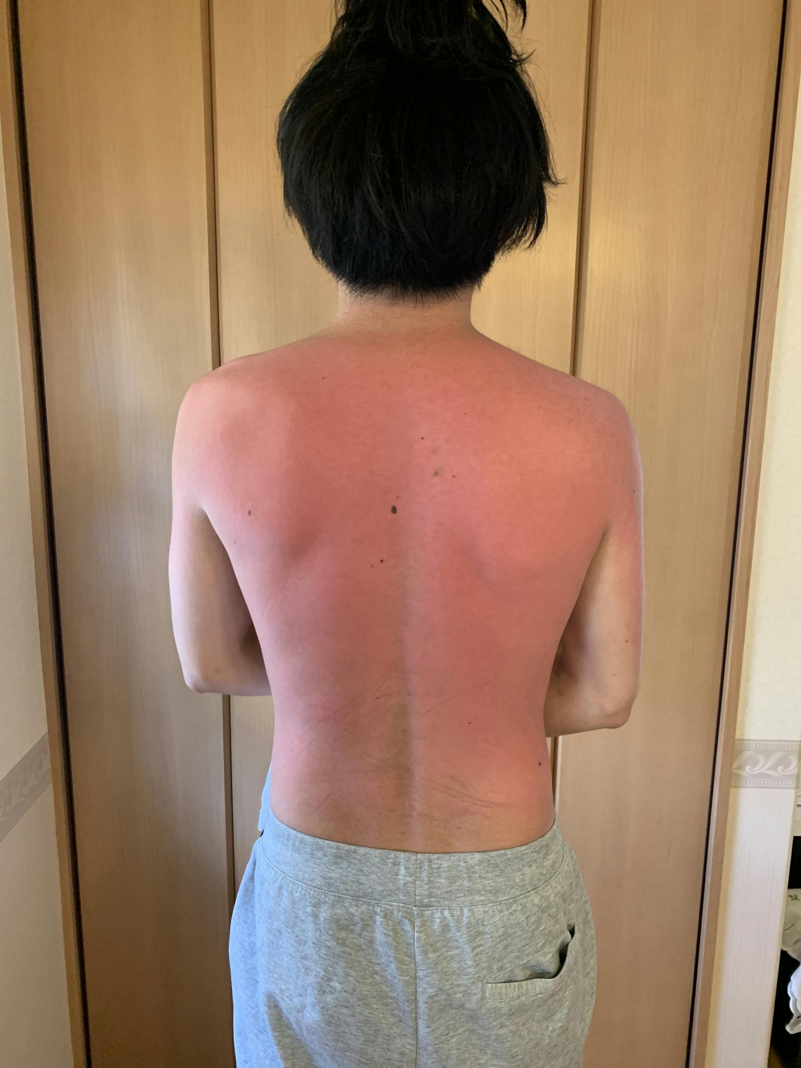 日焼けという名の火傷に負けず背中見せて動くマンでありたい CAMPFIRE