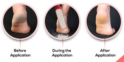 気になる足のかかとをお風呂前に5分のケアでツルツル足に 半永久角質除去 Campfire キャンプファイヤー 気になる足のかかとをお風呂前に5分のケアでツルツル足に 半永久角質除去 Campfire キャンプファイヤー