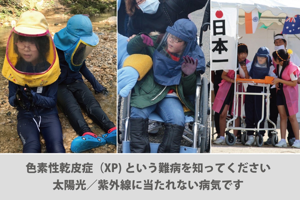 紫外線に当たれない難病 色素性乾皮症 Xp の子供たちのための防護服を作りたい Campfire キャンプファイヤー