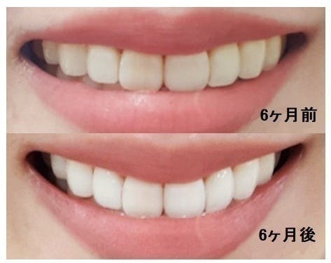 歯がツルツル！】ステインを除去して輝く笑顔へ。スイス生まれの音波